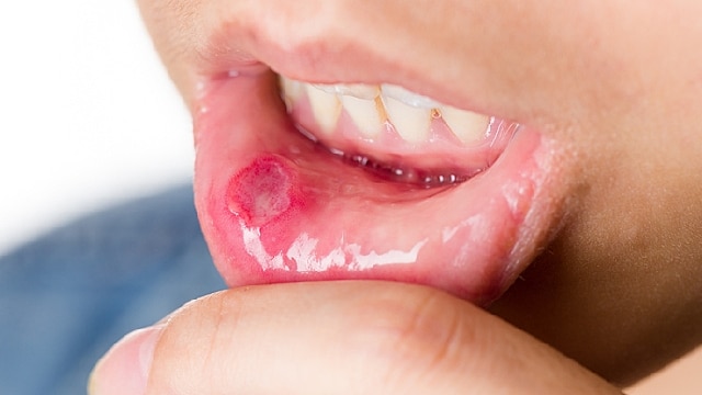 Infections buccales courantes