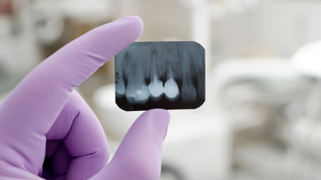 Mini radiographie des dents d’un patient
