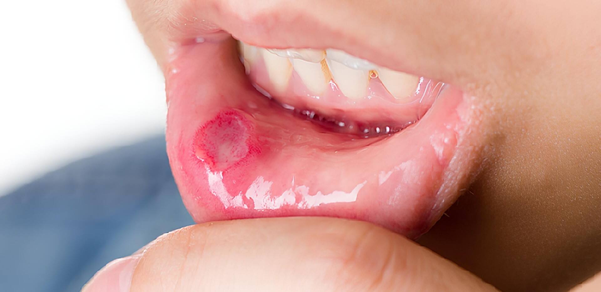 infection dans la bouche